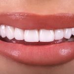 Veneers: A New Era in Personalised Dental Artistry