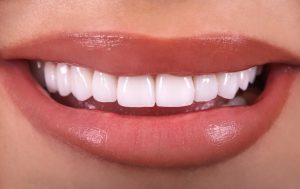 Veneers: A New Era in Personalised Dental Artistry